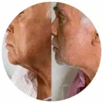 Papada + Rejuvenescimento